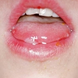 بیماری خشکی دهان